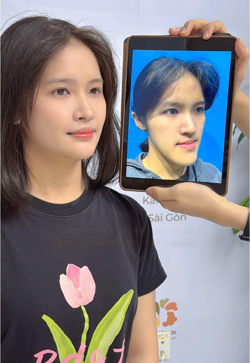 Ngược thời gian để thấy sự thay đổi sau khi chỉnh hàm móm tại Kangnam #chinhham #thammy #kangnamsaigon 