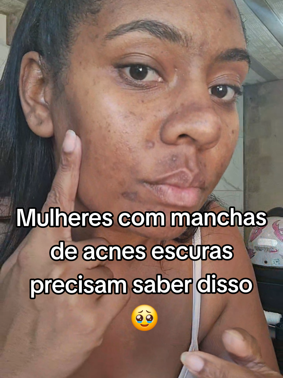 Não aguentava mais olhares estranhos pra mim 😭 até encontrar esse clareador #fypシ゚ 