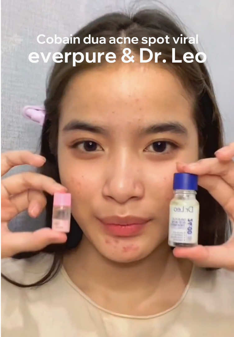 Cobain 2 produk untuk jerawat, wajib checkout biar kulit glowing maksimalll 💗💗💗 #acnelotion #obatjerawat #acnedryinglotion 