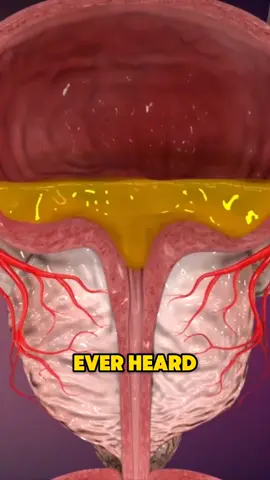 Shrinking Enlarged Prostate Without Surgery! Prostate Artery Embolization Explained 💡🇺🇸 #ProstateHealth #BPHRelief #MensHealth #ProstateArteryEmbolization #MinimallyInvasive #UrologyTips   #HealthFacts #USAHealth #Over40Health #MedicalExplained #TikTokDoc #NoSurgeryNeeded #HealthForMen 