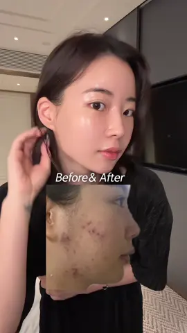 문제성 피부였던 내가....🤢#kopher #kbeautyskincare #코페르 #kbeauty #skincare 