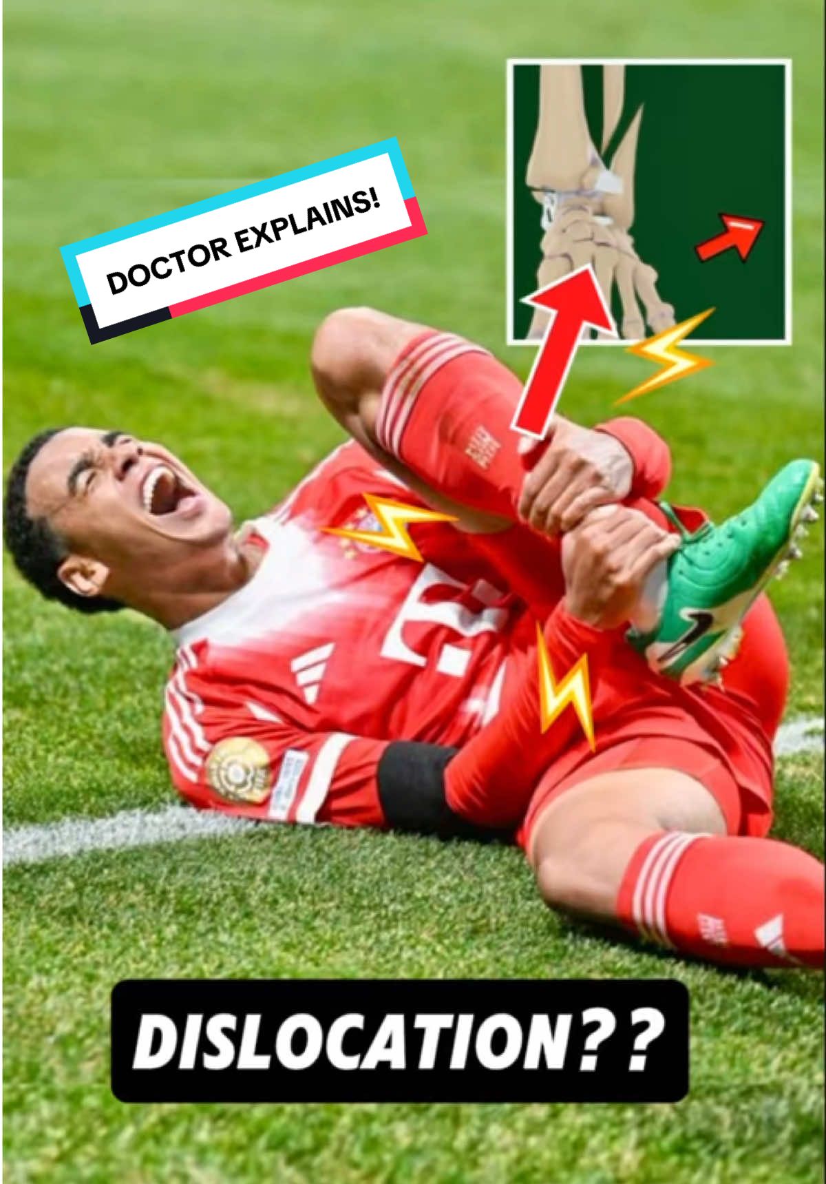 #fcbayern’s #JamalMusiala suffered an ankle fracture dislocation last night during the #FIFACWC QF against #PSG, let’s break this down . . . #clubworldcup #Soccer #injury #education #sportsmedicine #fcbayernmünchen #sportscenter #espn #anatomy #Science #medicaltiktok 