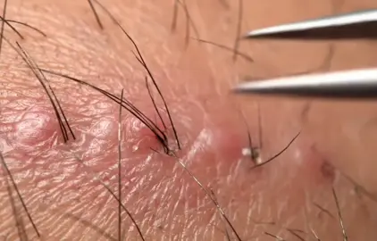 ดึงขนคุดใต้คางทีละเส้น ลึก เสียว สะใจ! Beard-zone ingrown hairs — deep pull, clean root, pure thrill.