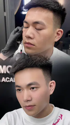 TRỊ THÂM LÀM ĐẦY HỐC MẮT !!! CAM KẾT DỨT KIM LÀ ĐẸP !!! #filler #botox #Tiêmfillerđẹphànội #dạytiêmfilleruytín #daotaohocvienchuyennghiep #botox #trithamquangmat #trending 