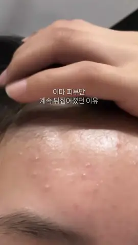 이마만 난리났던 이유..생각지도 못한거라 아직도 황당하네요;;  #추천추천 #fyp #피부고민 #관리자님추천뜨게해주세요  