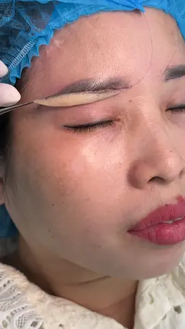 Nâng cung giấu chỉ xử lí da chùng #nangcung #nangcungchanmayrutchi #nangcungmay #nangcungchanmay #xuhuongtiktok #xuhuong 