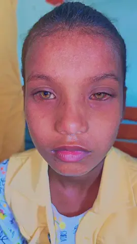 🔍 Case Challenge 👧🏻 10-year-old girl 📍 C/O: Itching, redness & watering — both eyes, for 1 month 👀 BCVA: 6/6 both eyes ⸻ 📸 Take a look at this eye. There’s something unusual in the limbal area… What would you consider first in your differential diagnosis? 🤔 🩺 Drop your thoughts in the comments! We’ll share the diagnosis soon 👇 #r#retinao#oftalmoo#ophthalmologyo#oftalmologiao#oftalmologíao#ophtalmologieо#офтальмологіяо#офтальмологияο#οφθαλμολογίαo#ophthalmologists#e#eyehealthv#visione#eyez#zeissbrasilv#visulasgreenbrasilc#clarusbrasilr#retinographyv#visulasm#medm#medede#eyediseasem#medicalschoolm#medicalstudents#Scienceretina