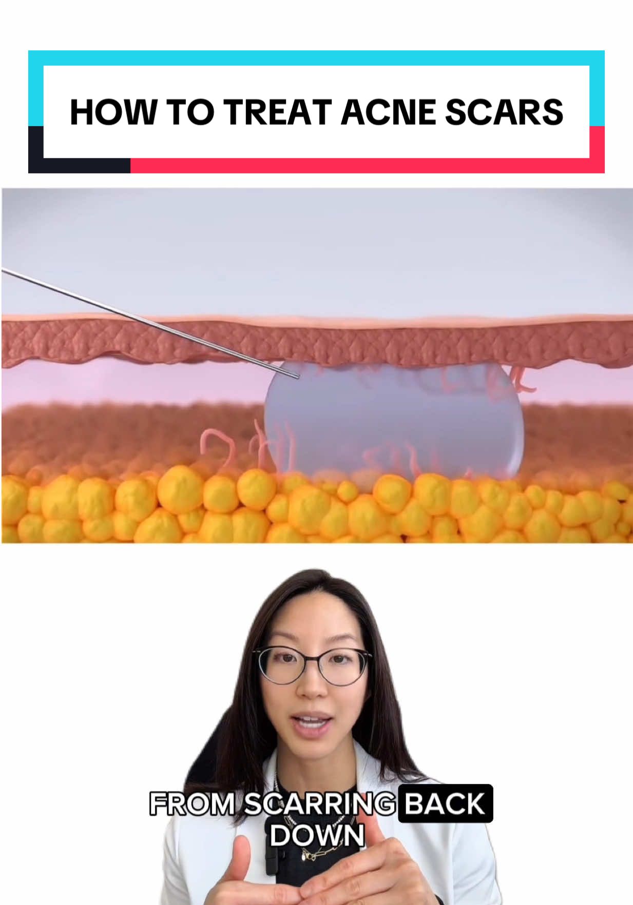 Subcision is a procedure that gets rid of depressed acne scars and this is how it works. 🤯 In some cases, it’s combined with other treatments like microneedling, laser therapy, or dermal fillers to further enhance the results.✨ #plasticsurgery #plasticsurgeon #BeautyTok #surgerytok #aesthetics #acnescartreatment #acnetreatment #acnescars 