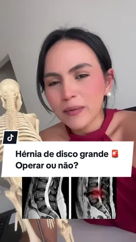 O tamanho da hérnia de disco NÃO determina a gravidade da dor nem se você vai precisar operar. Um estudo publicado no Journal of Neurosurgery: Spine avaliou 283 pacientes com hérnia de disco lombar e ciática. Alguns foram tratados com cirurgia, outros com tratamento conservador. E o resultado? Após 1 ano, ambos os grupos apresentaram melhora semelhante na dor da perna, independentemente do tamanho da hérnia visto na ressonância magnética. Pacientes com hérnias grandes não necessariamente tinham mais dor do que aqueles com hérnias menores. O que realmente importava era se a raiz nervosa estava comprimida e o quanto a dor na perna estava presente no início do tratamento. 👉 Por isso, não tome decisões baseadas apenas na imagem da ressonância. A avaliação clínica é essencial para definir o melhor tratamento! ⸻ Referência: El Barzouhi A, Verwoerd AJH, Peul WC, et al. Prognostic value of magnetic resonance imaging findings in patients with sciatica. J Neurosurg Spine. 2016;24(4):178-186. doi:10.3171/2015.10.SPINE15588. . #hernia #herniadiscal #herniadedisco #coluna #fisioterapia #ciatico 