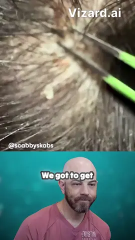 Are scalp issues bringing you down? Let's talk about seborrheic dermatitis and how to tackle it effectively! 🌟 It's time to focus on the right approach—it's not just about removing flakes with tweezers at the barbershop! 🛑 The key lies in choosing the right shampoo to address the root cause of the problem. That pesky irritation could be hiding more than meets the eye. 🤔 Discover why I only remove isolated scabs in specific cases and how we can maintain overall scalp health! Don't let scabs steal your shine! ✨ Dive into scalp care that works! 💧🧴 #SeborrheicDermatitis #ScalpHealth #HairCareTips #Skincare #HealthyScalp #DandruffSolutions #GroomingTips #DermatologyAdvice #SelfCare #WellnessJourney #ScalpConditions