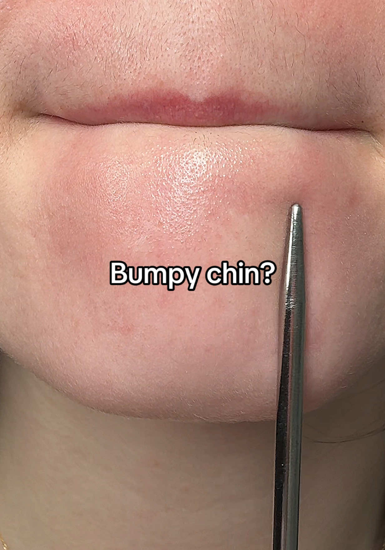 Acne prone / Congested / Oily/ Combination / Bumpy / Rough Skin these are your best skincare Ingredients part 1