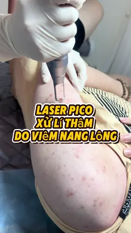 Laser Pico xử lí thâm do viêm nang lông để lại 🥰 #drlamay #congnghecao  #bsdalieu #trimuncantho  #thamnam #bsdalieuthammy @BS. CKI Huỳnh Vân - Dr. LaMay @BS. Phương Lam - CK1 Da Liễu 