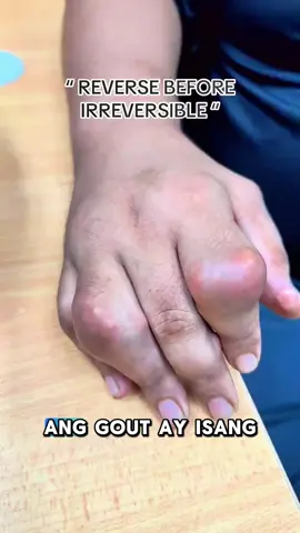 Idikit lang, wala nang sakit, gaan na ang lakad#GoutPatch #GoutRelief #JointCare #HealthyLiving #gout #goutpatch #patch #ZL