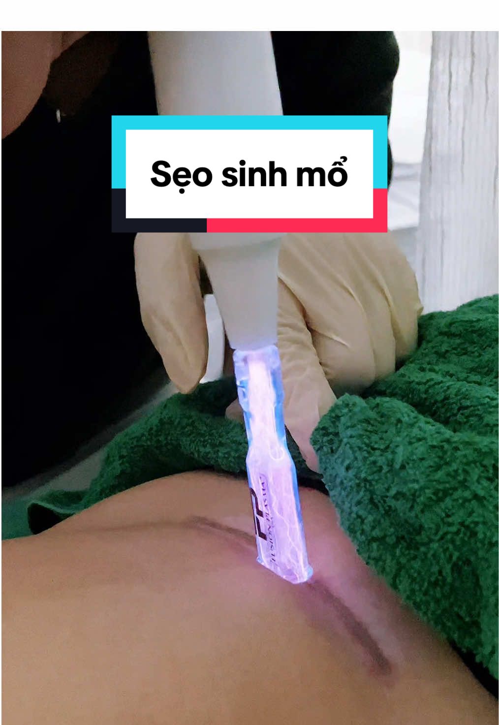 Sẹo do sinh mổ #spanhatrang #xuhuong #trend #plasma #coldplasma #fyp #viral #trending #spa 