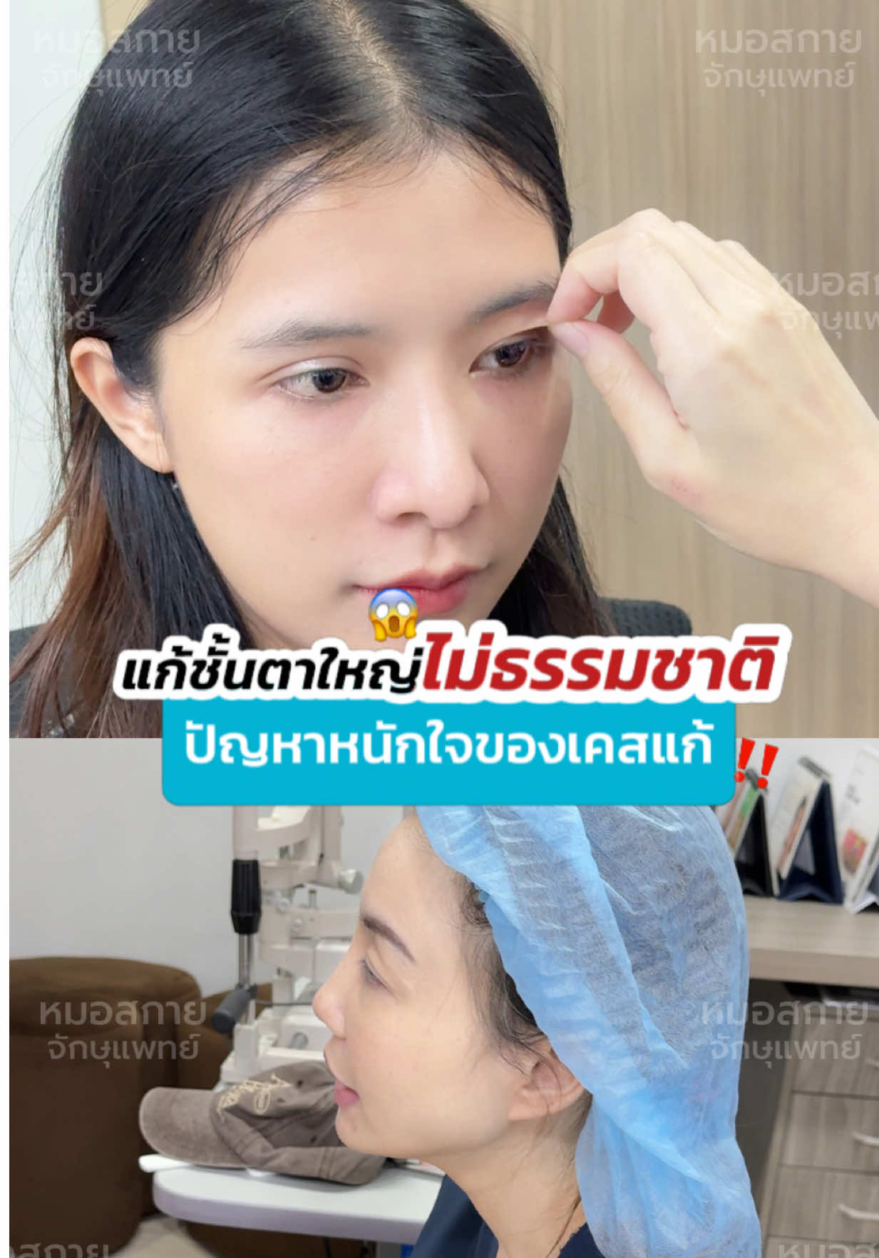 ปัญหาใหญ่ของเคส #แก้ตาสองชั้น  คือชั้นตาไม่ธรรมชาติ‼️ #รีวิวเคสแก้ตาสองชั้น #ตาหอยแครง  #หมอสกาย #จักษุแพทย์ #หมอตา #สกายคลินิก #ทำตาที่ไหนดี #หนังตาตก  #skyclinic #ศัลยกรรมตา