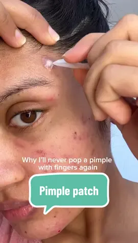 The way this pimple patch said “I got you bestie” and pulled out my entire soul 💀 The Q-tip? Soaked it up like it was born for this job. Don’t watch this while eating. You’ve been warned. #pimplepatch #acnepatch #pimplepatchremoval #pimplepatchpeel #acnepatches #cysticance #acneskin #acnetok #skintok #satisfying #patchly #grossbutsatisfying 