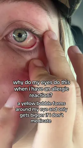 Doctors of tiktok!! My eyes will literally sweat shut if i don’t do anything about the weird bubble #allergicreaction #doctorsoftiktok #allergy #allergydoc #doctoradvice 
