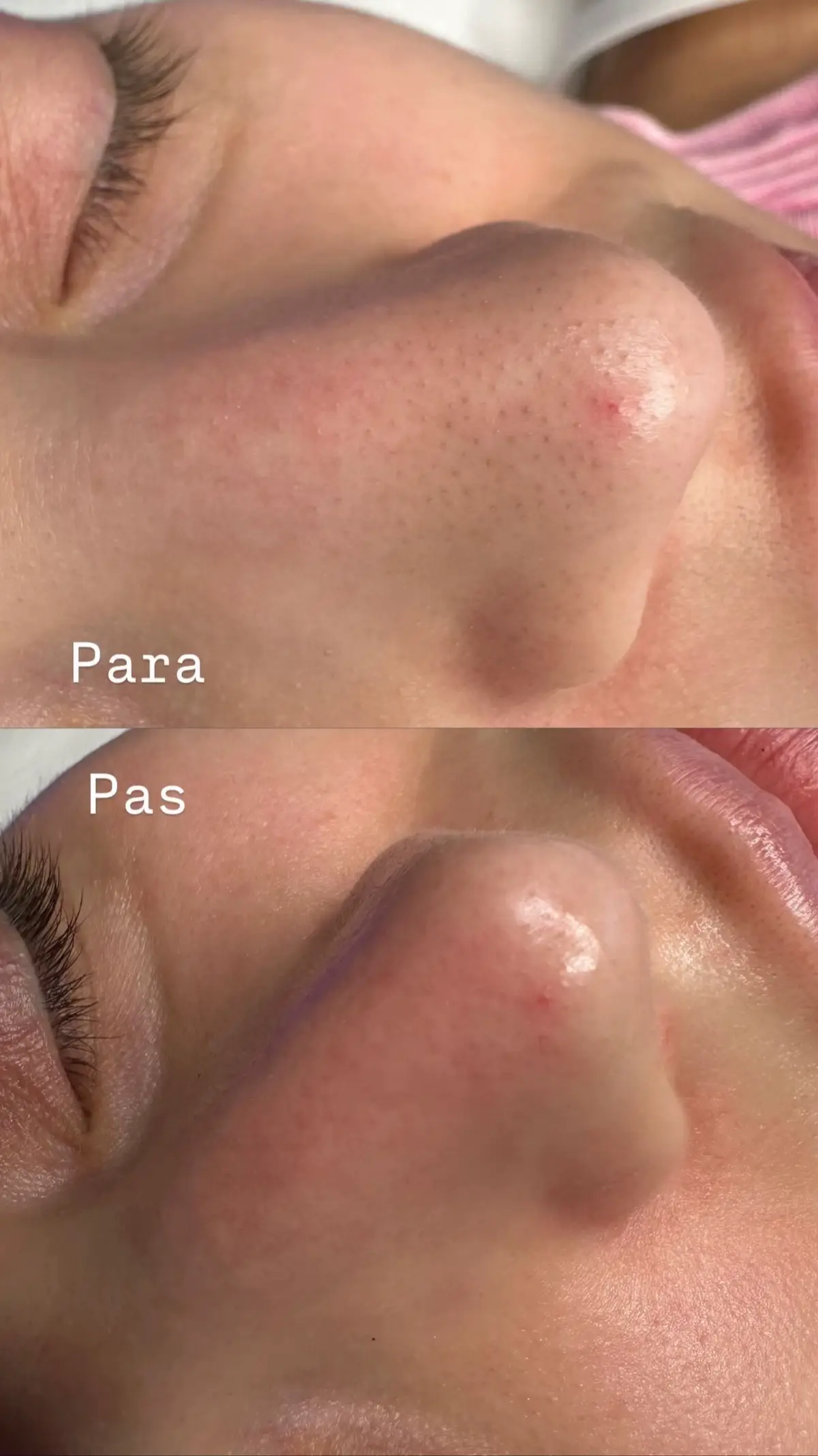 #skin #fyp #hydrafacial #beforeandafter #bleackheads #acne 