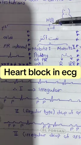 heart block in ecg