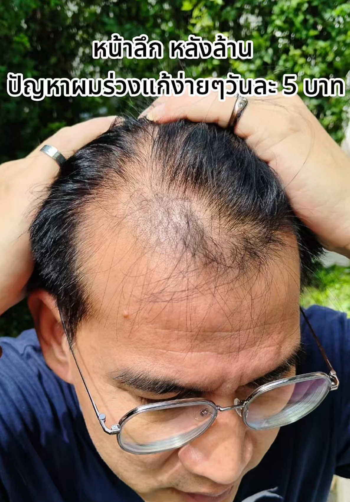 วันล่ะ 5 บาท จบปัญหาผมร่วง ผมบาง หัวล้าน แค่ฉีดเท่านั้น ง่ายๆกับปลายนิ้ว #สเปรย์ลดผมร่วง #theorientalspray #ลดผมร่วง #ลดผมบาง #หัวล้าน #ผมร่วง #ผมบางกรรมพันธุ์ #ผมบาง 