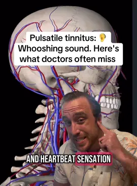 #pulsatiletinnitus #fyp 