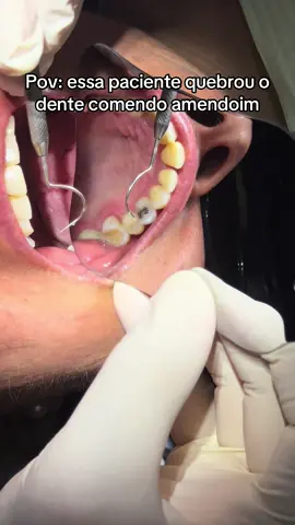 Dente com tratamento endodôntico e restauração extensa desadaptada, com infiltração… 😬 . . #odontologia #dentista #fyyy 
