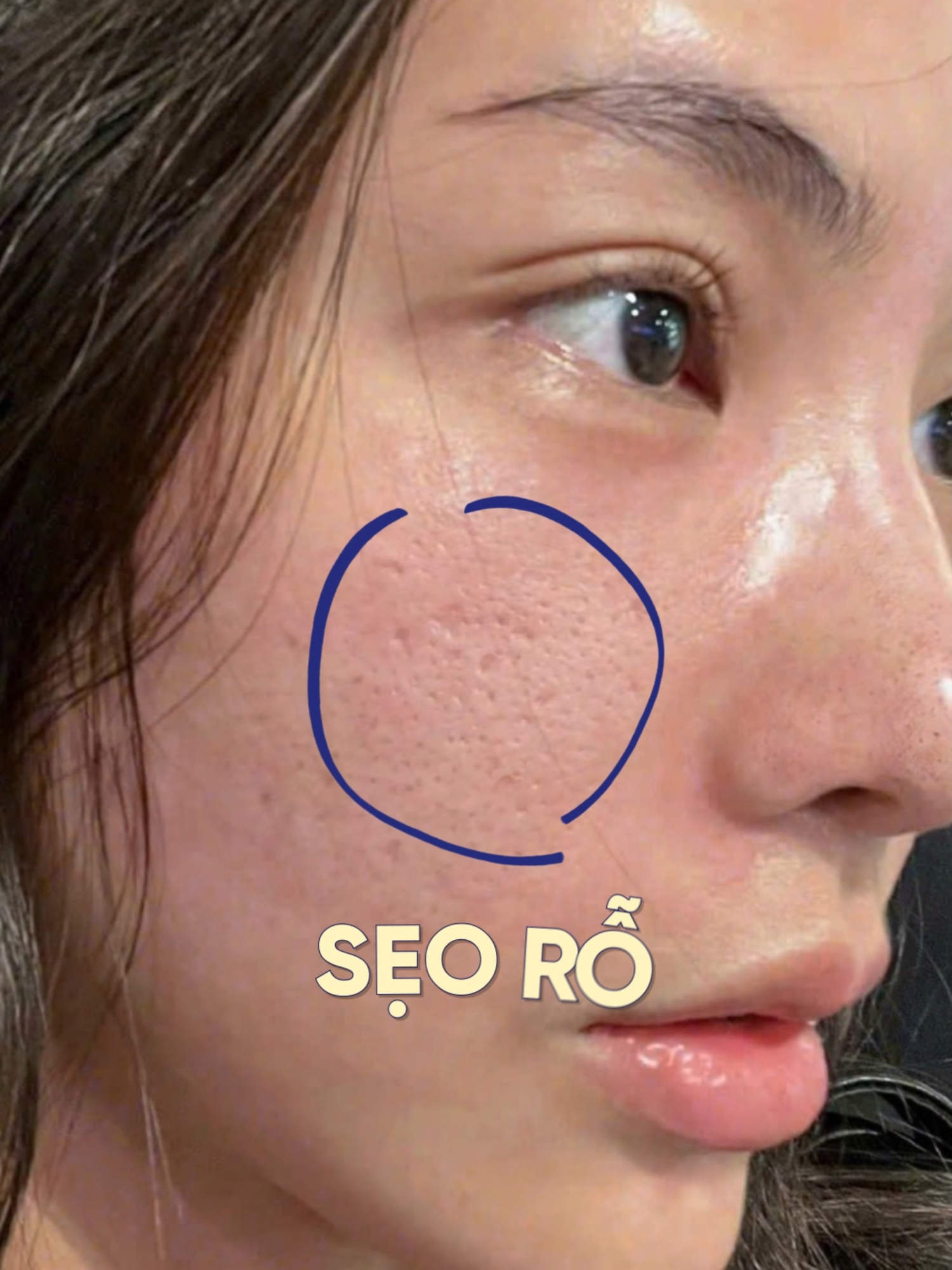 SẸO RỖ có thật sự điều trị hết được không? Câu trả lời là CÓ nha - Thử ngay Laser Fractional CO2 tại Ngọc Dung CHỈ 168K. Lấp đầy sẹo rỗ - Tái tạo là da chỉ sau 1 liệu trình. #tmvngocdung #seoro