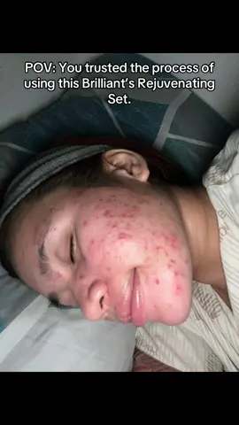 I used to struggle so much with acne—constant breakouts and uneven skin really took a toll on my confidence. But after consistently using Brilliant’s Rejuvenating Set, my skin started to clear up and smooth out. It wasn’t an overnight miracle (I even went through purging at first), but the results were so worth it. Clear skin is possible—just trust the process. #brilliantsrejuvenatingset #fromacnetoclearskin #skincarejourney #realresults #skincare #brilliant #brilliantskinessentials #acnetreatment #acnefighter 
