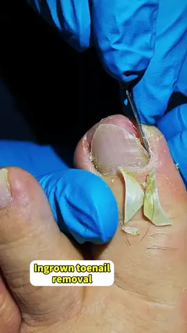 Before & After: The Ingrown Toenail Transformation! 👣 #toenailremoval #ingrowntoenail #pedicure #satisfying #viral #foryou #fyp