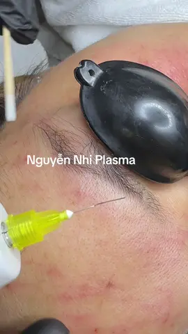 Cách xoá mày trổ đỏ bằng Plasma #dayplasmahcm #NguyenNhiTruyenNgheTuTe #Fibroblast #dayplasmaonline #xoamaykhongxamlan 