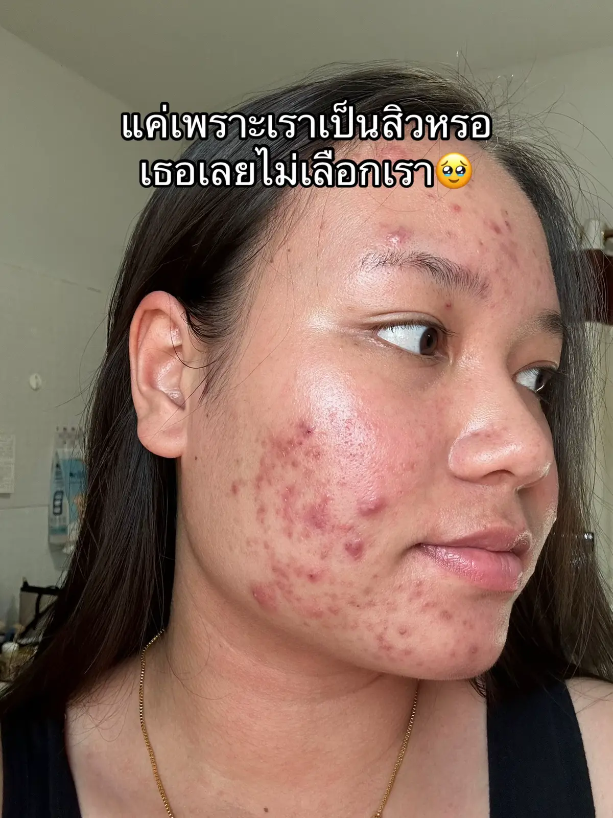 #ลาโบเช่ #ดูแลตัวเอง #เจ้าของแบรนด์ลาโบเช่ #นัทคนที่เป็นสิว #เป็นสิว #สิว #รักษาสิว 