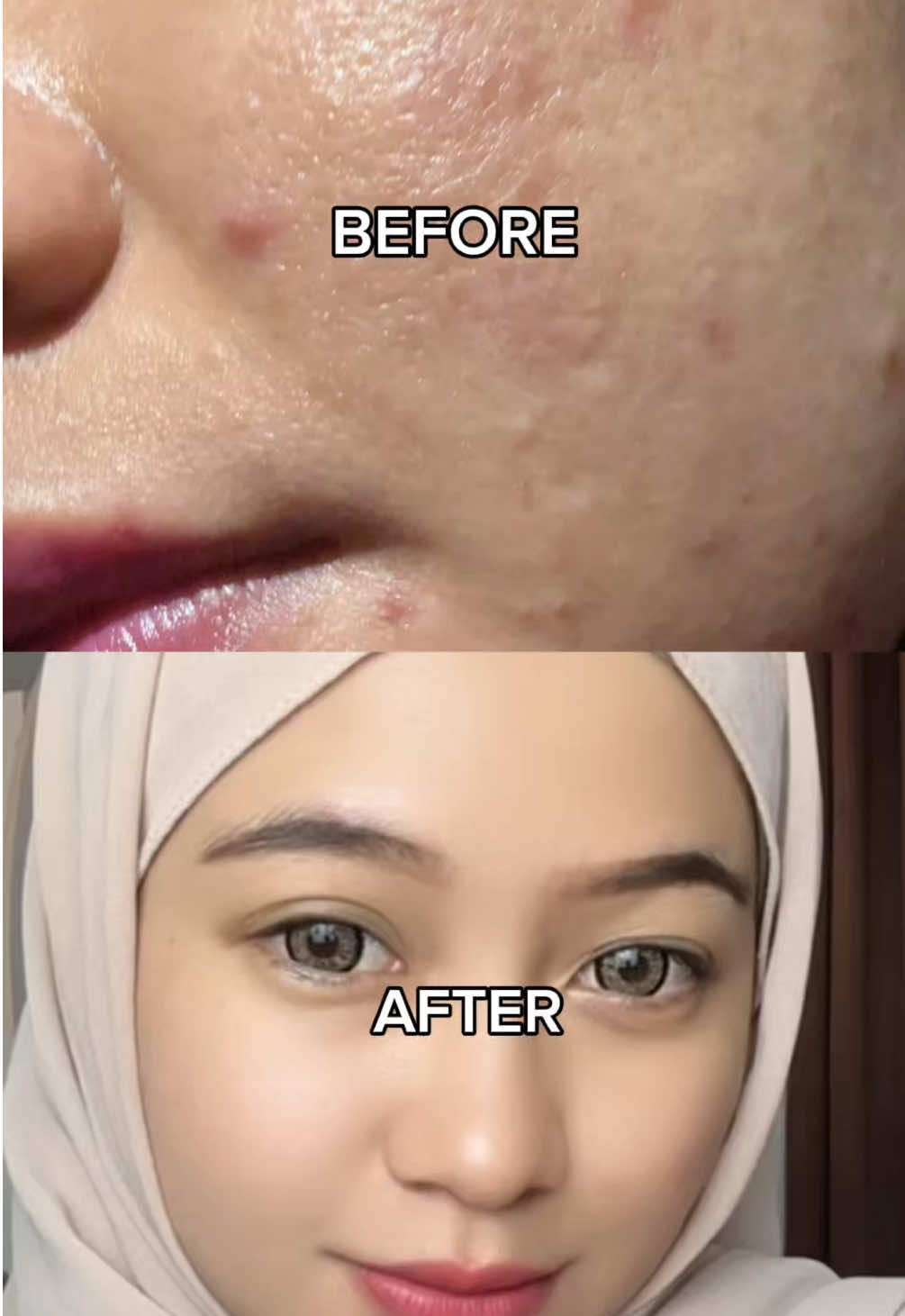 14 hr berjuang melawan jerawat bersama @Westcare Skincare Bener2 terharu🥹🥹💘 #14DaysWestcareWarranty #acnetreatment #acneprone 