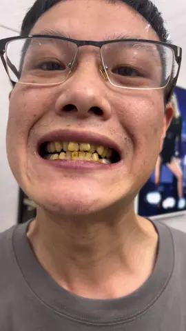 Used utogru toothpaste for a week my teeth actually got whiter! Real review #utogru  #toothpaste #yellowteeth #badbreath #teethwhitening #oralhealth #teethcleaning #tiktokmademebuyit #toothpaste #toothpaste #toothwhitening #gingivitis #badbreath #yellowteeth #teeth #tooth #teethwhitening #badbreath #toothdecay #foryou #TikTokShop #TikTokMadeMeBuylt| #teethcare #dealsforyoudays #teethwhitening #oralhealth #whiteningteeth #tiktokshopholidayhaul #FallDealsForYou #glamvorateethwhitening# TikTokShopSum merTurnUp #Hashtag #dealsforyouday
