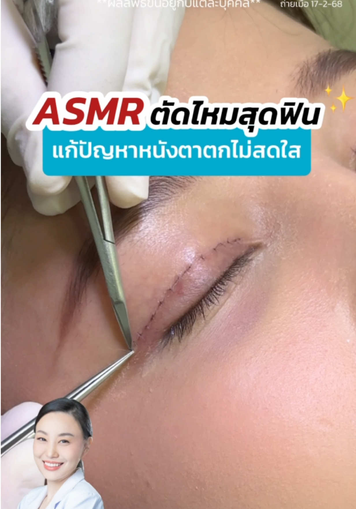 ASMR ตัดไหมสุดฟิน‼️ #asmr #รีวิวตาสองชั้น#หนังตาตก #ตาโหล  #หมอสกาย #จักษุแพทย์ #หมอตา #สกายคลินิก #ทำตาที่ไหนดี #หนังตาตก  #skyclinic #ศัลยกรรมตา