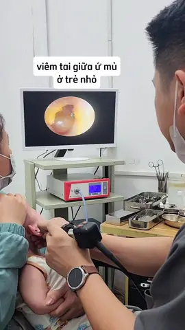 khổ thân bé, đau tai quấy khóc cả đêm, kèm theo đập tay vào tai. Bố mẹ thấy bé chảy mũi lâu nên đi khám nội soi tai cho bé, cảnh giác bé bị viêm tai giữa nhé! #viemtaigiua #bacsidungtran 