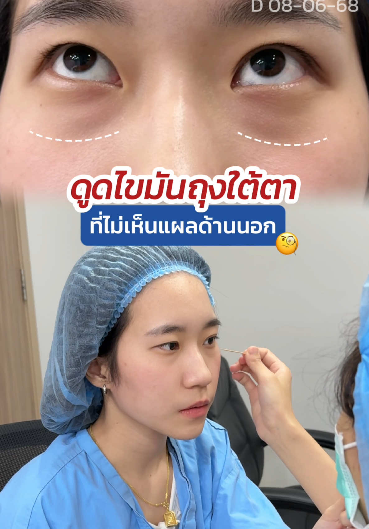 ดูดไขมัน #ถุงใต้ตา ไม่เห็นแผลจากข้างนอก ⁉️😲 #skyclinic #กำจัดถุงใต้ตาแผลใน #จักษุแพทย์ #ทีมแพทย์หมอสกาย #babylock #ทำตาที่ไหนดี 