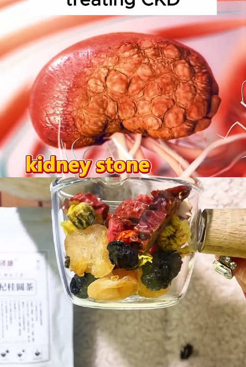 #kidneyteaformula #herbs #detoxdrink #kidneydisease #wellnesstips #kidneycare #fyp 