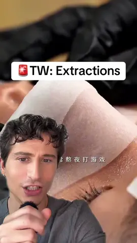 #duet with @Velza #skintreatment something to take the edge off. #dermreacts #skincare #dermatologist #reaction #reactionvideo #dermangelo #pimplepopping 
