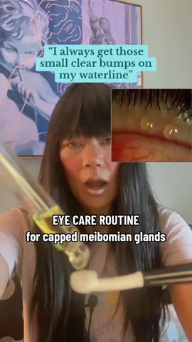 Clogging oil glands on the eyelid usually means Meibomian Gland Dysfunction 👀