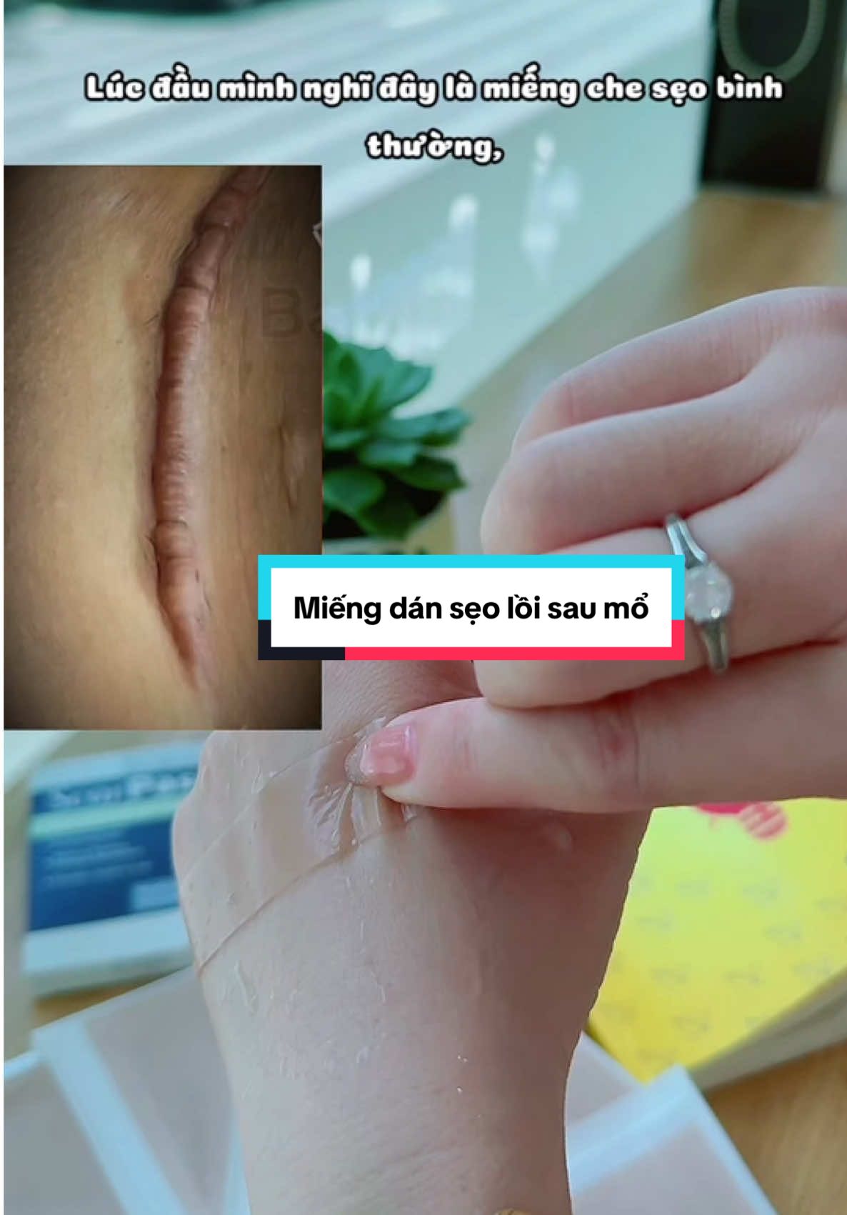Miếng dán làm phẳng sẹo sau sinh khi bị lồi  @methodaily8 #miengdanseoloi #miengdanseoloiscarpass #sausinh #mổ #xuhuong #xuhuongtiktok 