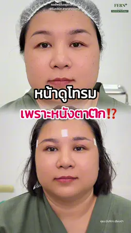 น่าดูโทรม เพราะหนังตาตก ⁉️ #fernclinic  #รีวิวเฟิร์นคลินิก #หมอเฟิร์นfernclinic #หนังตาตก #Subbrowlift  #lessscartechnique #เย็บแผลซ่อนไหม #หมอเฟิร์นเย็บซ่อนแผล 