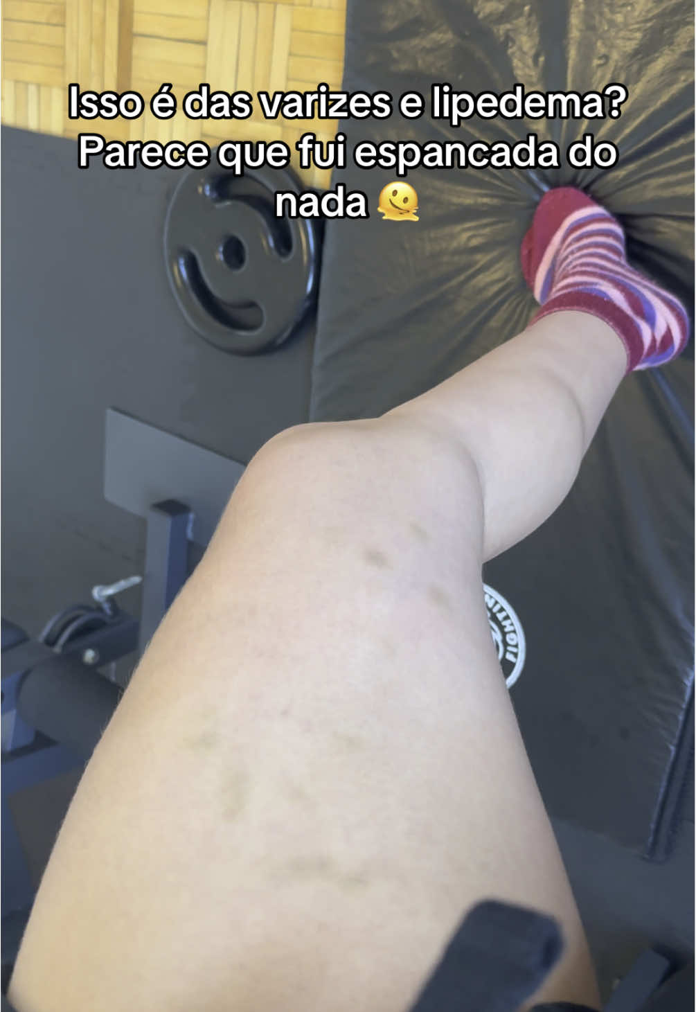 Já estou na segunda caixa de Dobeven 500 e não melhorou em nada o inchaço… #lipedema #varizes #pernasinchadas #hematomas #purpura 