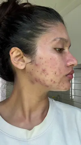I get so many comments asking how I treated my acne, dark spots & scars so I made a free guide. If you want it, it’s in my bio 🤍  #acne #acnescar #skincareroutine #acnehealing #freeguide #acnecommunity #acnepositivity #acneproneskin 
