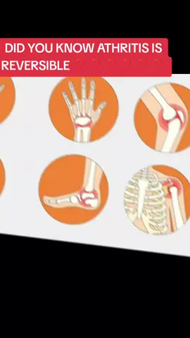 Comment to know how And how I can be of help #RheumatoidArthritis #healthisyourwealth #bonehealthmatters #goviral #ConsultantCaroline 