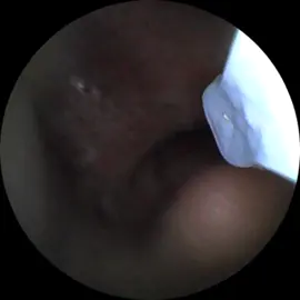 #earwax #earwaxremoval #ear #soulear 
