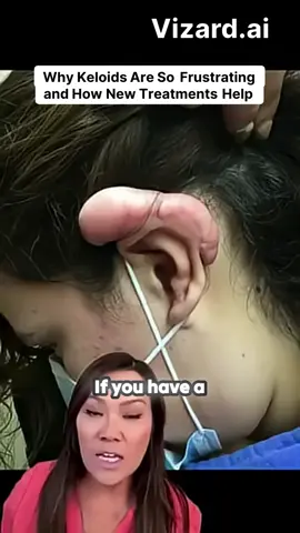 Keloids can feel like an endless battle, right? They're not just skin blemishes; they are frustrating reminders of trauma that can be both painful and embarrassing. From piercing mishaps to acne scars, these raised scars can pop up on various parts of the body like the chest, shoulders, or abdomen, often leaving us feeling self-conscious. But there’s hope! Traditional excision often leads to recurrence because, let’s face it, surgery is still trauma to the skin. That's why innovative treatments like superficial radiation therapy (SRT) are game-changers! 🌟 Imagine the relief of treating a large keloid and preventing it from coming back, all while allowing your skin to normalize over time. Join the conversation on effective solutions! Discover how modern advances can significantly improve keloid treatment outcomes with fewer fears of those stubborn scars returning. Check out some transformative results that show just how much better things can get. 💖 Ready to take control of your skin health? Say goodbye to the embarrassment and hello to newfound confidence! #Keloids #ScarTreatment #SkinCare #HealthTips #RadiationTherapy #ConfidenceBoost #Dermatology #SkincareRoutine #TransformYourSkin #SelfCare #HealingJourney #AcneScars #BodyPositivity #BeautyCare
