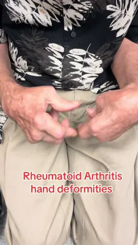 Severe hand deformities with Rheumatoid Arthritis #tiktokdoctor #physician #familymedicine #medicalstudents #premed #premedstudent #sportsmedicine #sportsmed #tiktokdoc #rheumatoidarthritis #arthritis #handarthritis 