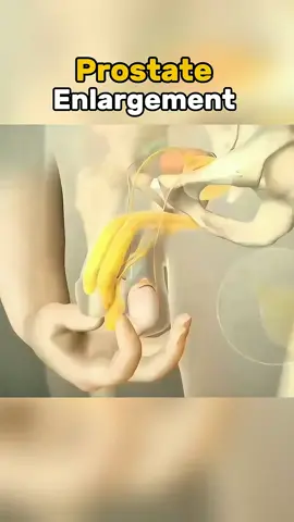 Prostate enlargement. Men's over 50 this could save you trouble .  Disclaimer: This video is for educational purposes only and is intended to raise awareness about medical procedures. It does not violate  TikTok community guidelines and contains no graphic or harmful content. #ProstateHealth #MensHealth #BPH #HealthAwareness #TikTokDoctor #Urology #HealthTips #HealthTok #ProstateEnlargement #MedicalTikTok 