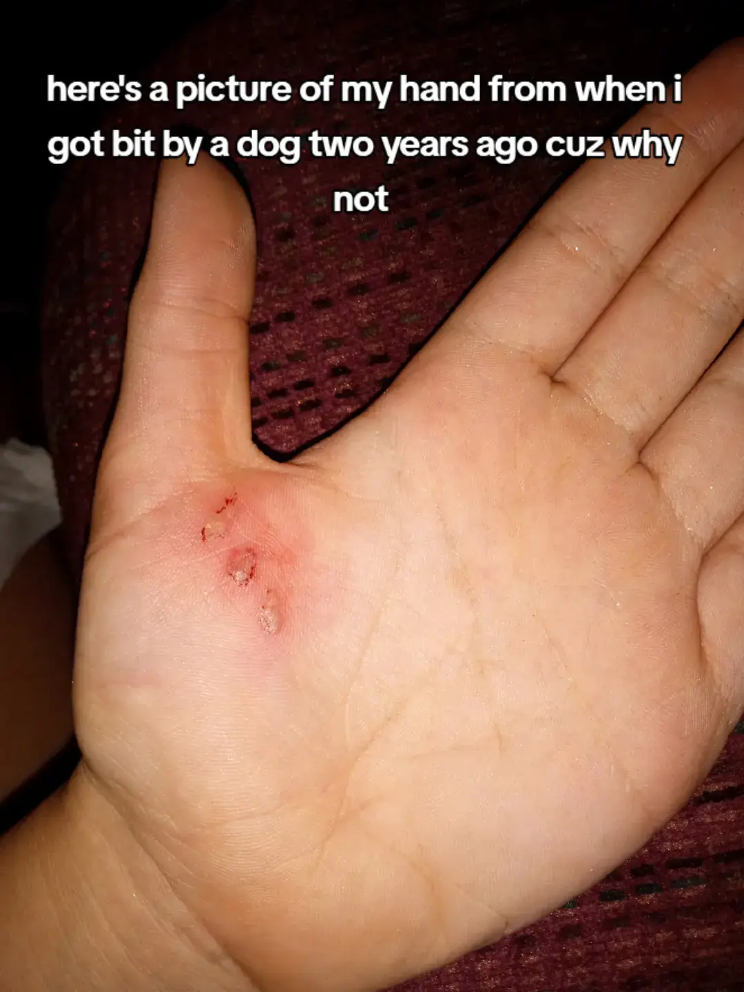 it hurt for days 😔