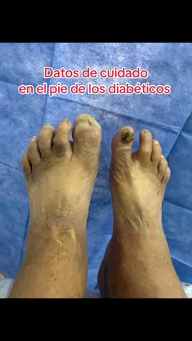 Lesiones de cuidado en el pie diabético #clinicapiediabetico #ulcera #diabetico #prevencionpiediabetico #tratamientopiediabetico #piediabetico #diabetes